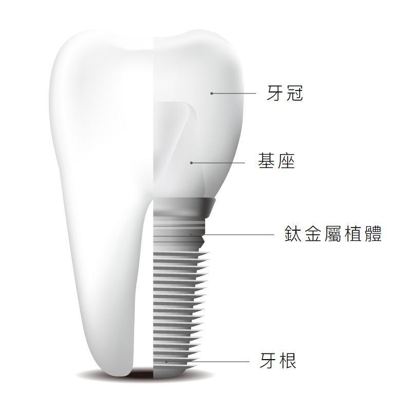 DENTAL IMPLANTi