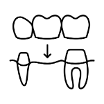 dental bridge