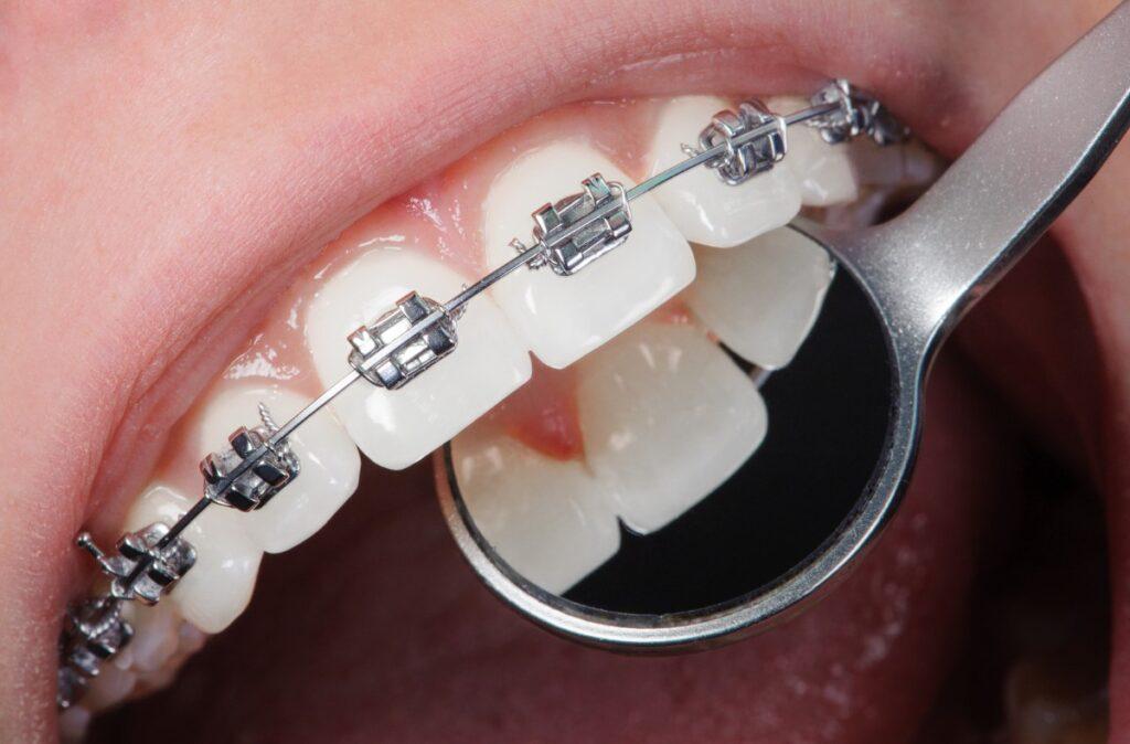orthodontics8
