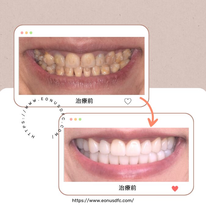 全口牙齒美容計劃