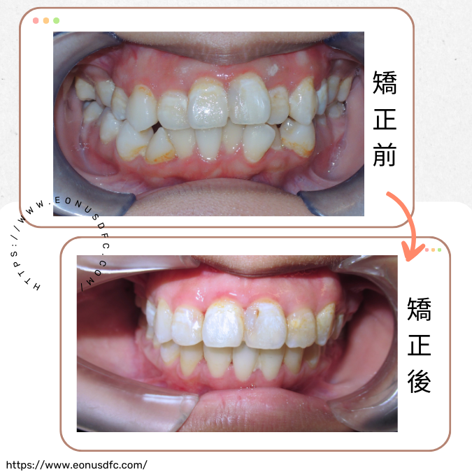 專業牙科團隊協同治療-矯正