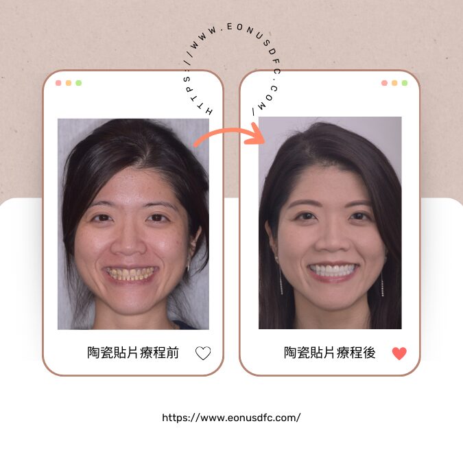 全口牙齒美容計劃
