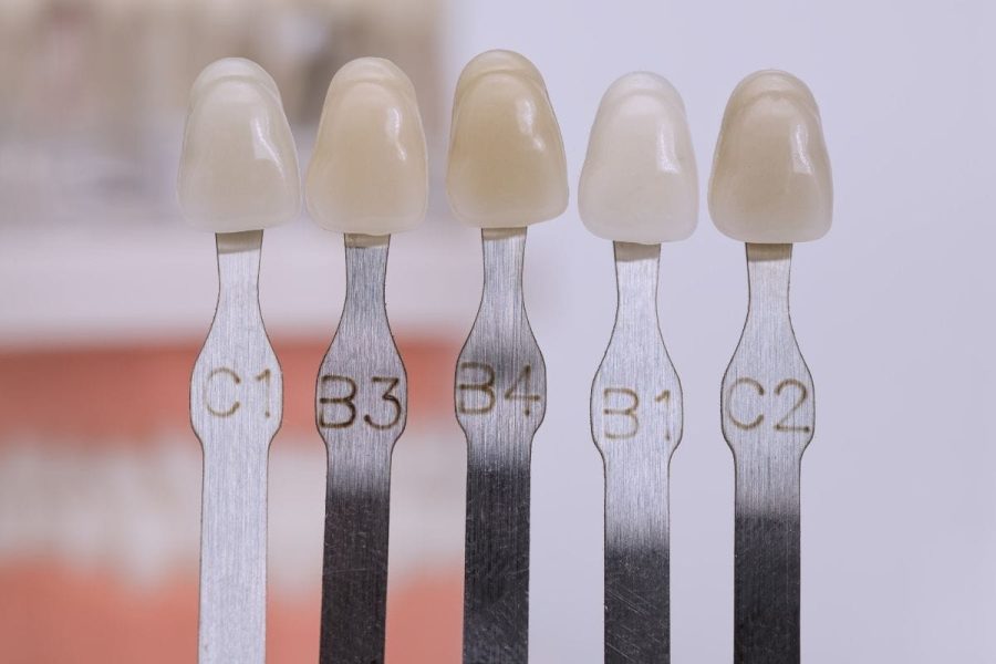dental-veneers-aftercare-maintenance-guide